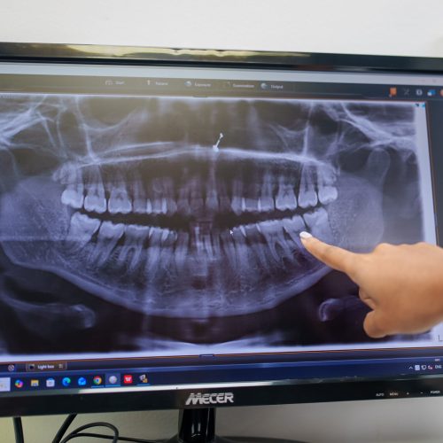 bite plate cost south africa